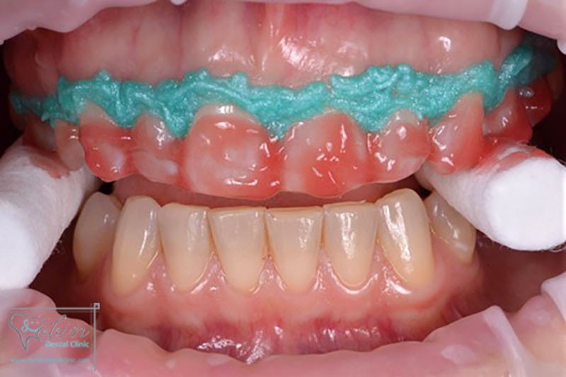 جرم گیری دندان ها با مواد حاوی پراکسید تا یک سال می تواند دوام داشته باشد